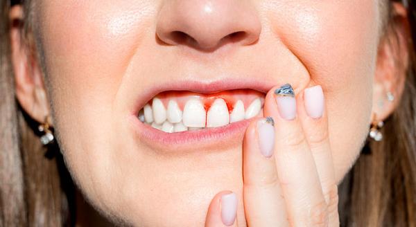 Gingivita - afectiunea gingiilor care poate duce la pierderea dintilor