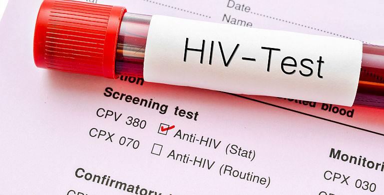 HIV si SIDA: care este legatura?