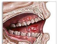 Controlul oncologic preventiv in stomatologie