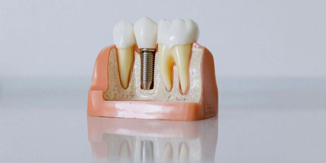 Dinti ficsi pe implanturi, reabilitarea completa pe care o puteti face. Ce presupune aceasta?