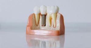 Dinti ficsi pe implanturi, reabilitarea completa pe care o puteti face. Ce presupune aceasta?