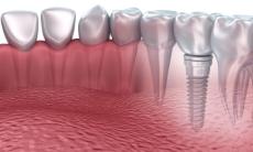  Implanturile Dentare din Zirconiu vs Implanturile din Titan