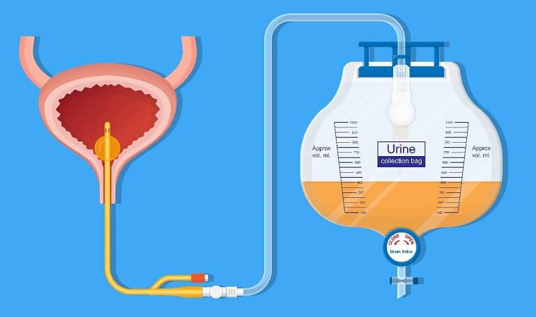 Infectii urinare asociate utilizarii de cateter urinar