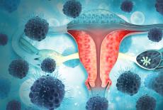 Infectia trompelor uterine (Salpingitele)