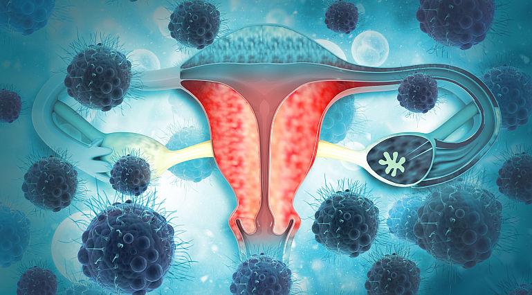 Infectia trompelor uterine (Salpingitele)