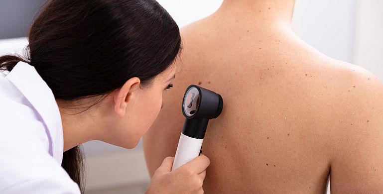 Melanomul poate fi prevenit?