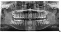 Implicatiile molarului de minte asupra sanatatii orale