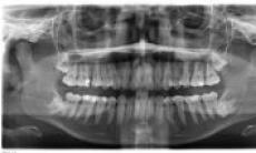 Implicatiile molarului de minte asupra sanatatii orale