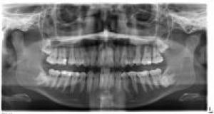 Implicatiile molarului de minte asupra sanatatii orale