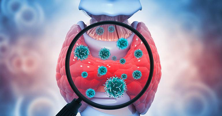 Tumorile neuroendocrine