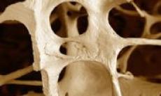Osteoporoza si sanatatea oaselor