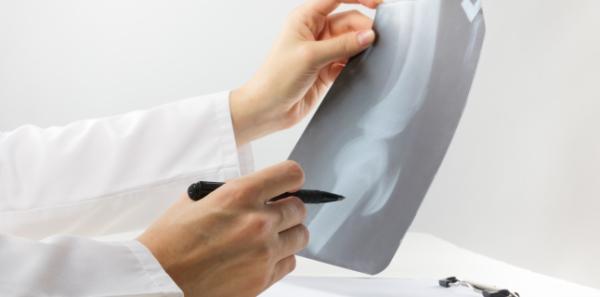 Se poate preveni osteoporoza?