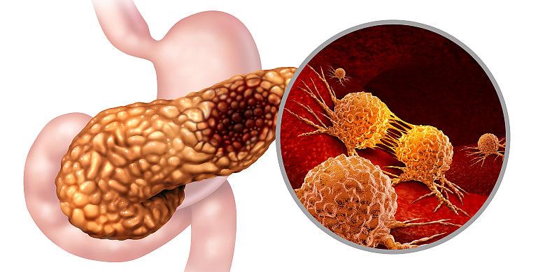 Pancreatita cronica (Inflamatia cronica a pancreasului)