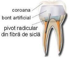 Pivotii de fibra de sticla