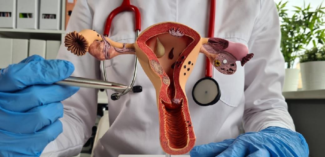 De ce este esentiala indepartarea polipilor uterini, chiar si fara simptome?