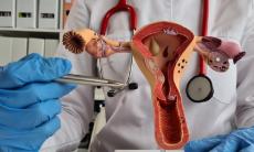 De ce este esentiala indepartarea polipilor uterini, chiar si fara simptome?