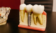 Reabilitarea completa a danturii pe implanturi: ce presupun procedurile All-on-4 si All-on-6