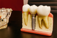 Reabilitarea completa a danturii pe implanturi: ce presupun procedurile All-on-4 si All-on-6