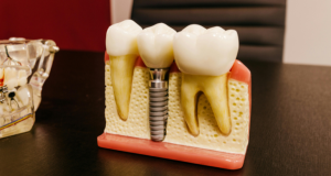 Reabilitarea completa a danturii pe implanturi: ce presupun procedurile All-on-4 si All-on-6