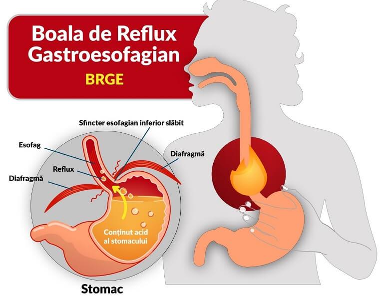 Refluxul gastric si boala de reflux