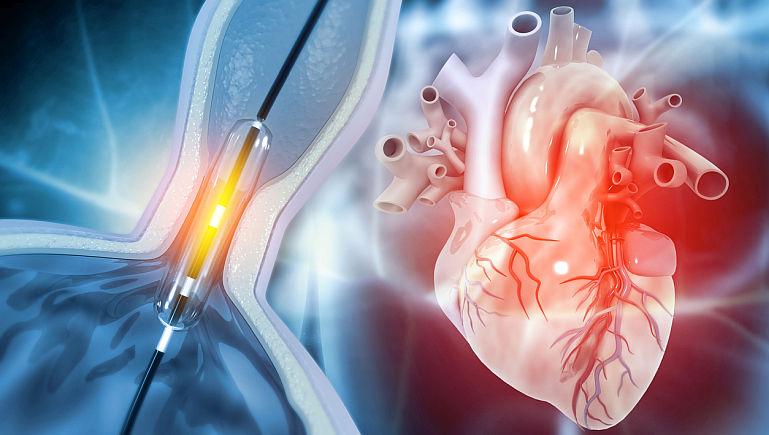 Reguli de urmat dupa implantul de stent