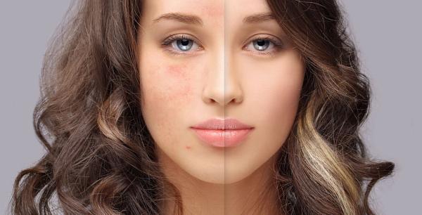 Ingrijirea tenului gras, cu tendinta acneica