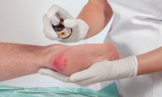 Preventia si tratamentul escarelor – O perspectiva moderna asupra managementului ranilor de decubit