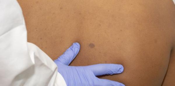 Tumorile benigne pot deveni maligne?