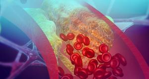 Vasculita necrozanta: afectiune care poate afecta orice vas de sange