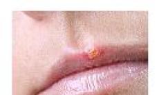 Virusul herpes simplex