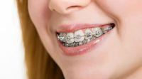 aparat dentar